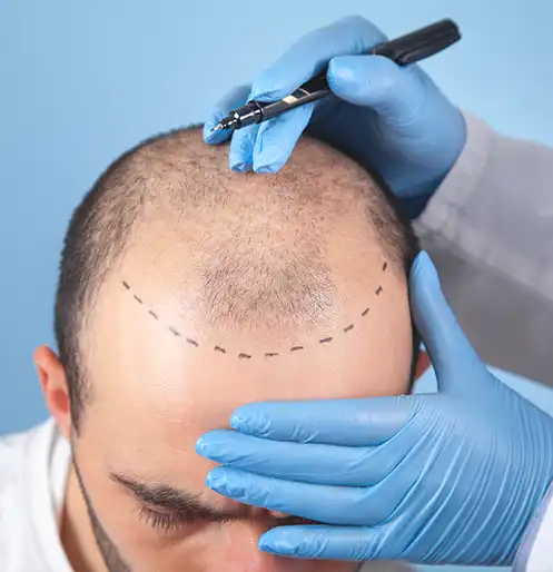 FUE Hair Transplant
