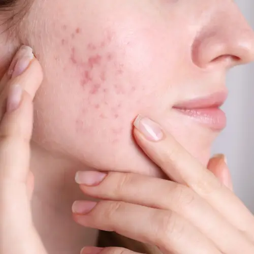 Open Pores Treatment